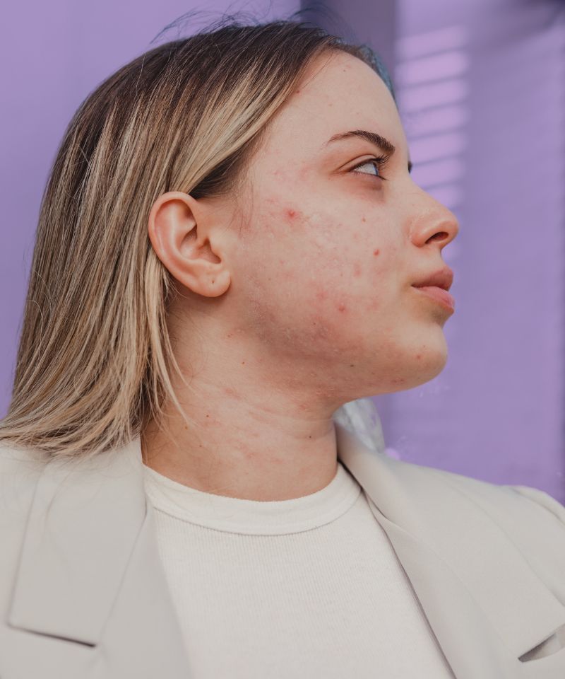  Visual depiction of hormonal acne caused by Polycystic Ovary Syndrome.