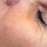 Best Treatments to Achieve Smooth Even Toned Skin