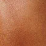 Sun Allergy Q&A: What to Know Before Summertime