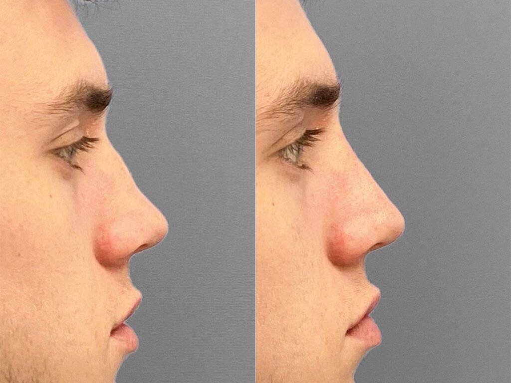 man before and after a non-surgical rhinoplasty