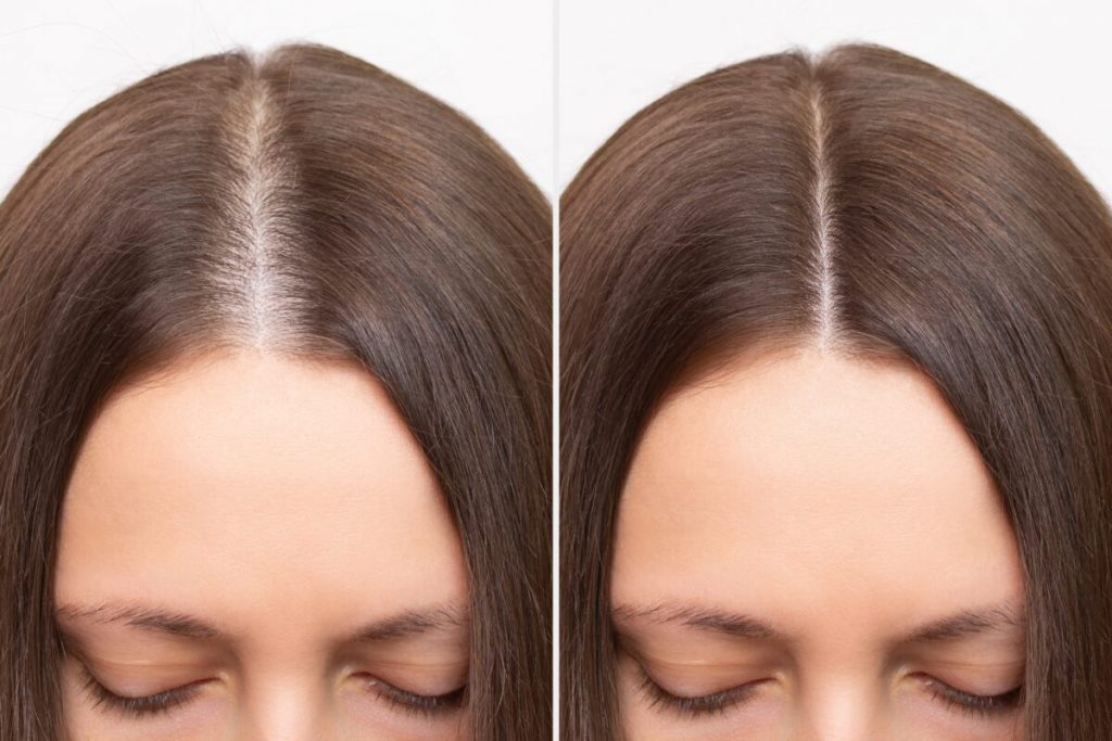 How to Improve Scalp Health? Eden Skin Clinic