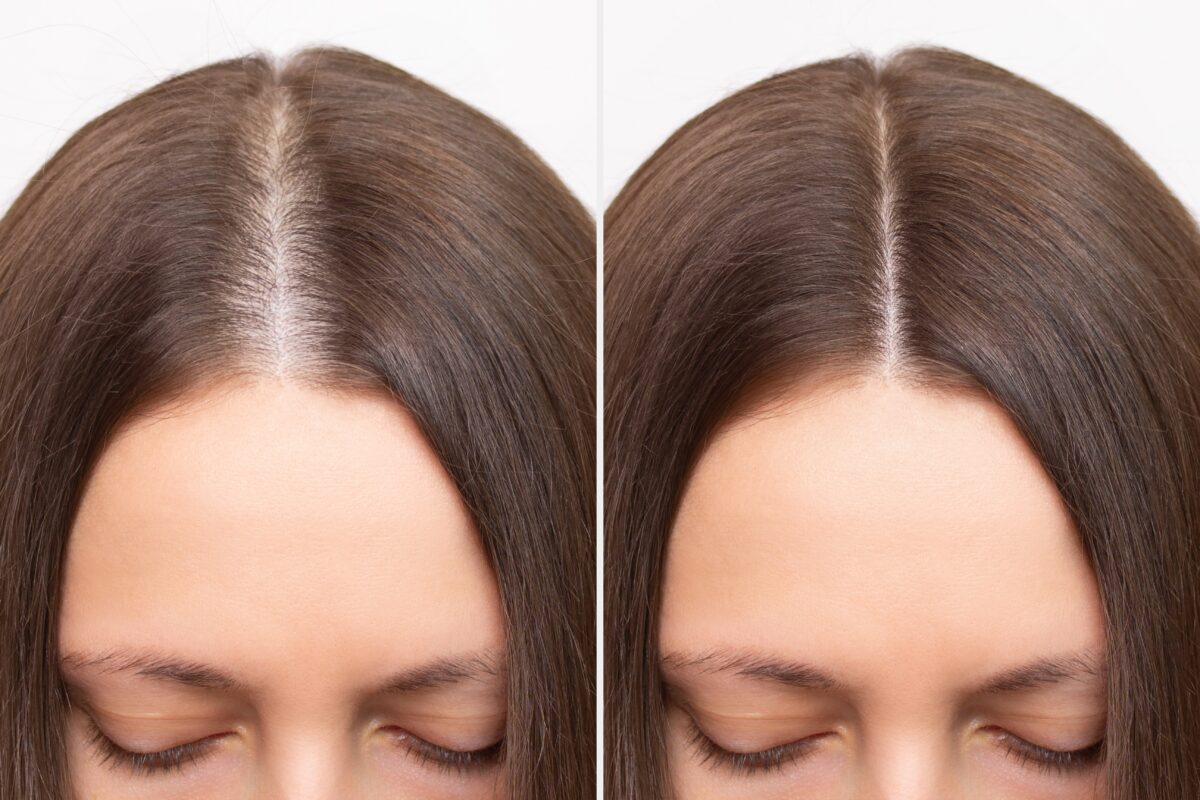 How to Improve Scalp Health? Eden Skin Clinic