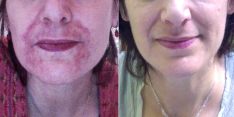 Perioral Dermatitis Lifestyle Changes