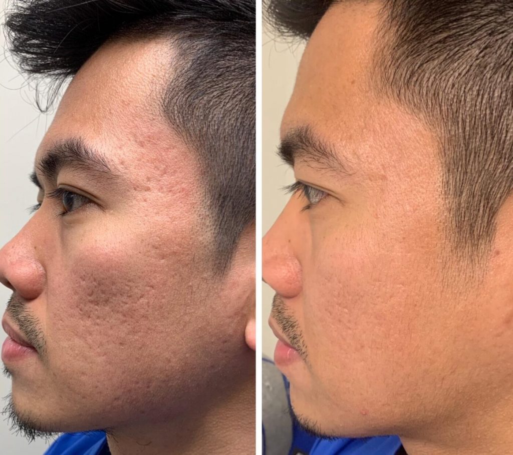 Popular Cosmetic Treatments For Men In 2024, According To A Doctor