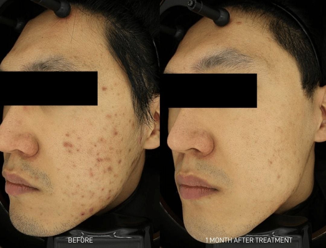 Man before and after exosomes for the face