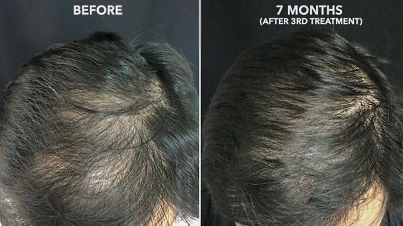 Man before and after PRP hair treatment 